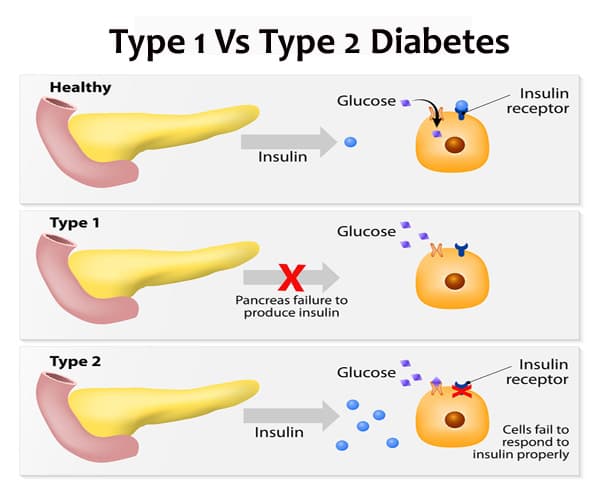 Type 2 diabetes is a chronic condition in which insulin receptors become desensitized and are not responsive to insulin.