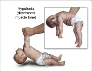 Hypotonia, commonly known as floppy baby syndrome , is a state of low muscle tone .