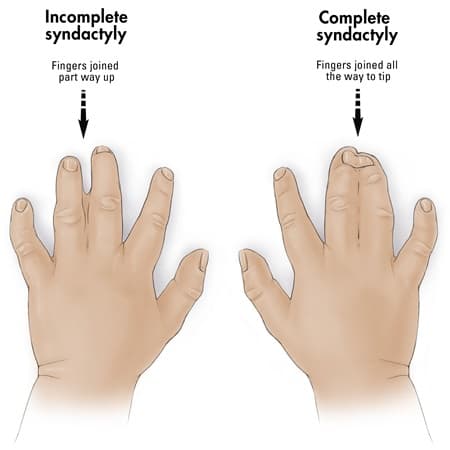syndactyly.ash: Apoptosis can be used for sculpting certain anatomical structures.