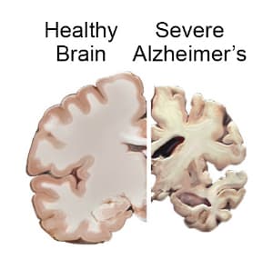 Alheimers Brain Atrophy: Biological factors related to Alzheimer’s disease include: Genetic factors Brain atrophy Low acetylcholine Senile plaqu…
