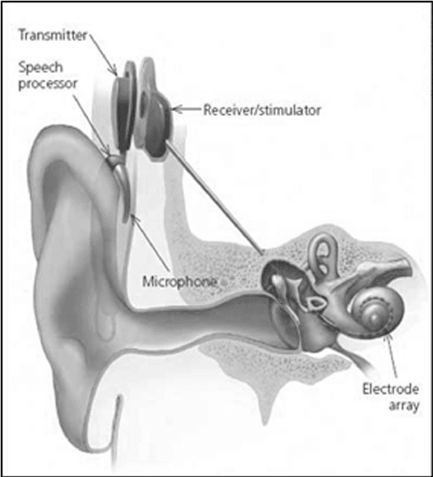 Cochlear Implants: A cochlear implant is a small, complex electronic device that can help to provide a sense of sound to individuals with…