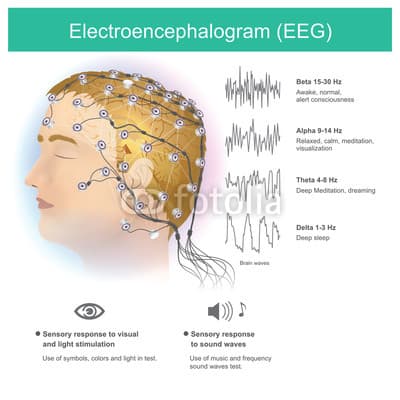 A/an electroencephalogram (EEG) is a test that detects electrical activity in your brain using small, metal discs (elec…