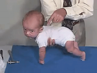Galant reflex is when a baby's skin is stroked, the baby moves to the side it was stroked