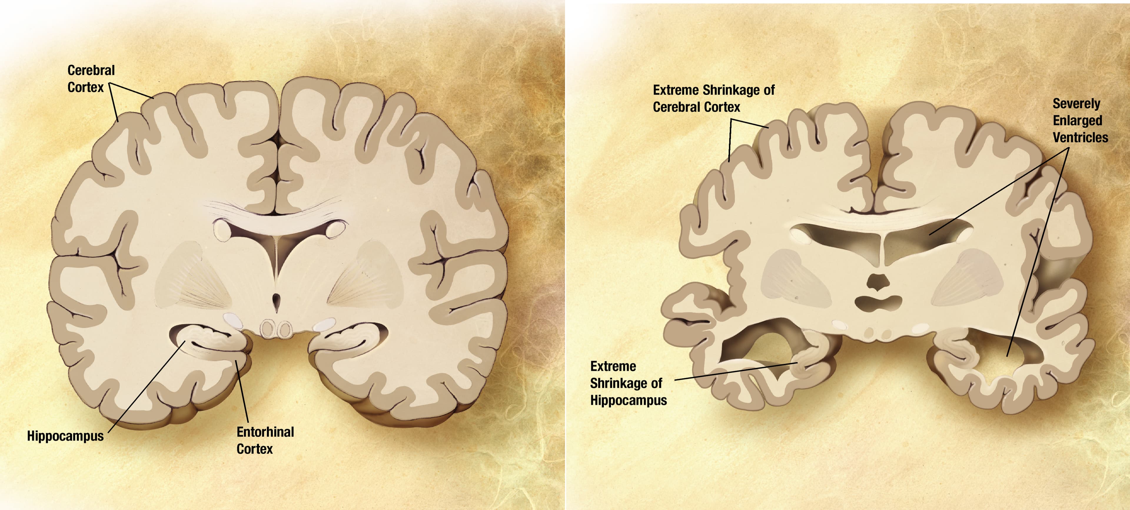 Alzheimer s disease brain comparison: The most common form of dementia is Alzheimer's Disease