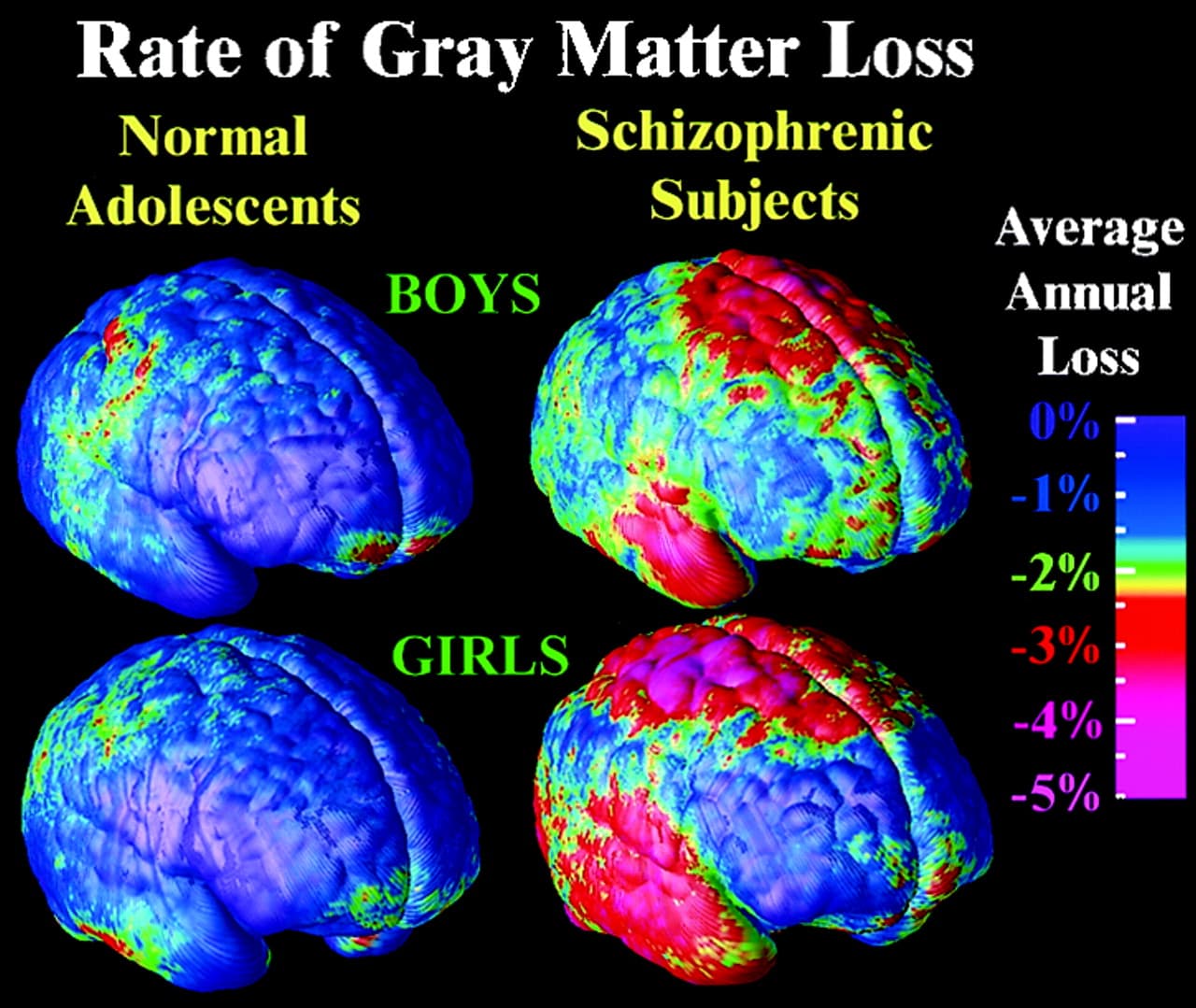 F3.large: The physical abnormalities associated with schizophrenia include decreased cerebral cortex size (frontal/temporal), enl…