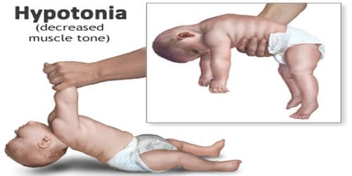 Hypotonia is decrease in tone of skeletal muscle