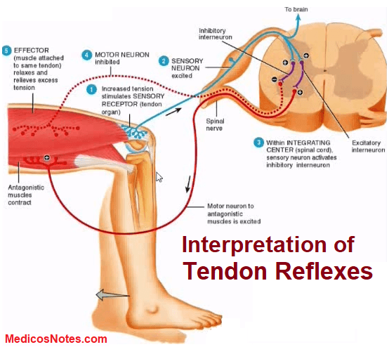 Tendon Reflex MedicosNotes com: Hyporeflexia is decreased muscle stretch reflex