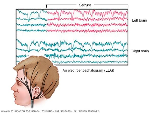 bn7 eeg results 8col: EEG is noninvasive monitoring of the electrical activity of the brain using electrodes on the scalp