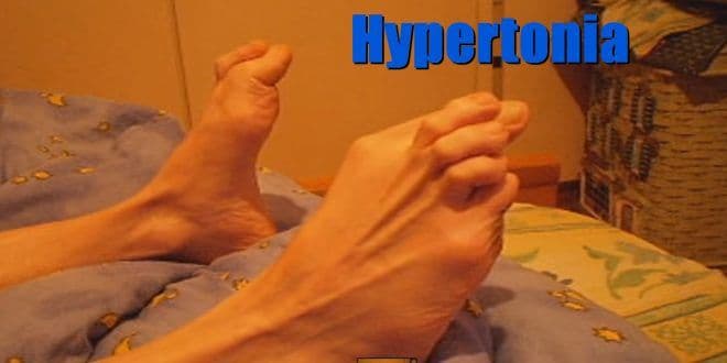 Hypertonia is increased tone of skeletal muscles