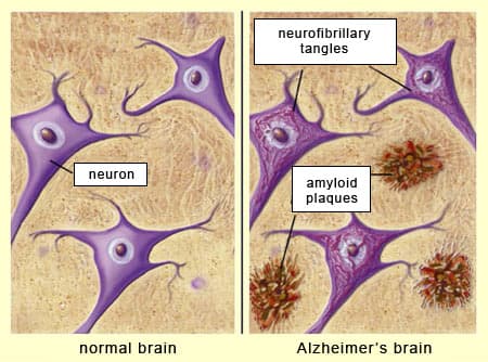 d 08 cl alz 1a: Alzheimer's is associated with a buildup of amyloid plaques in the brain