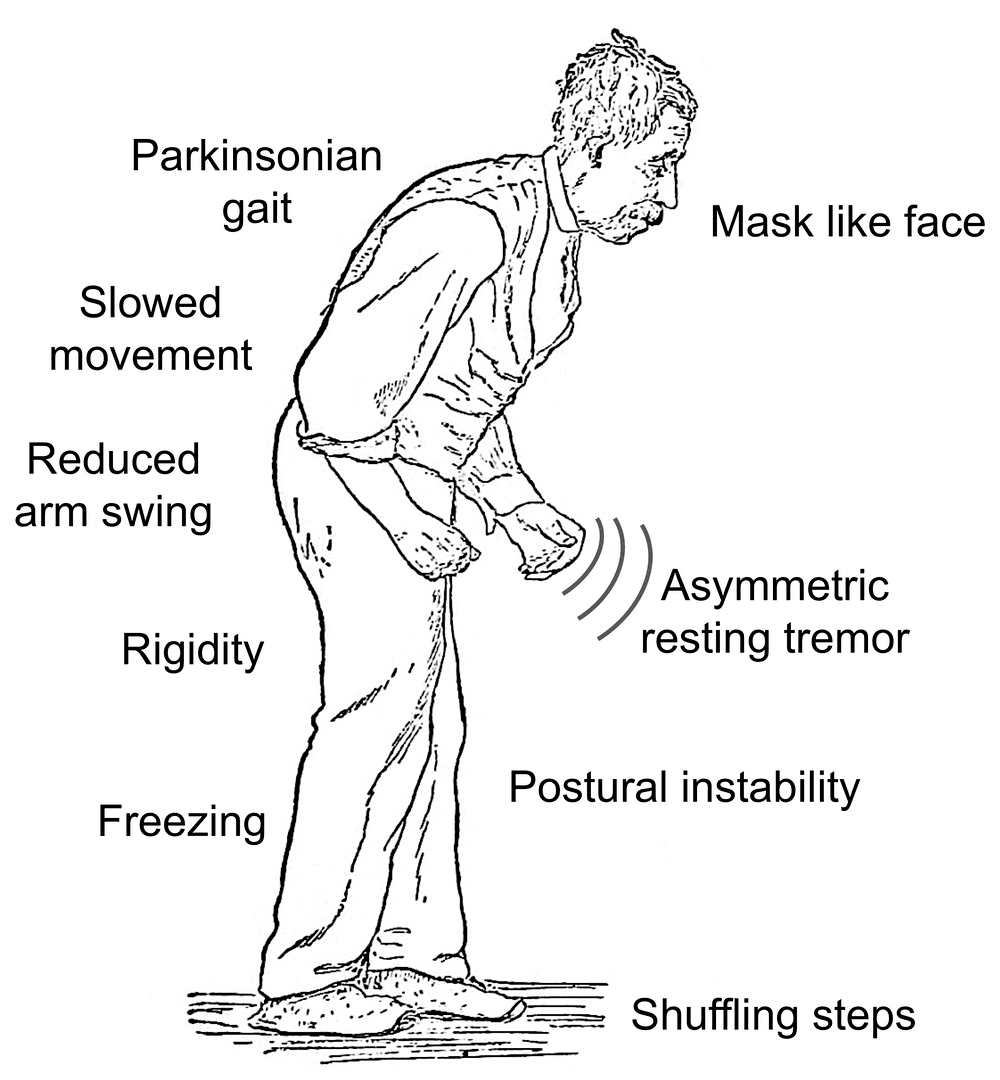 Parkinson's disease is associated with motor abnormalities and mental dysfunctions