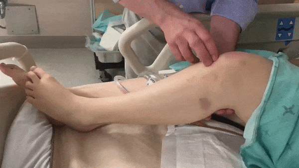 Hyperreflexia is an increase in the muscle stretch reflexes