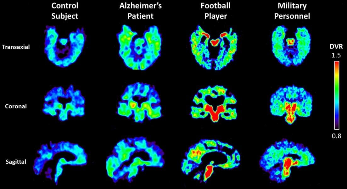 moleculartra: PET scans inject glucose into cells to analyze which brain areas are active at a given point of time