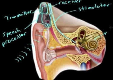 Cochlear implants are a surgical procedure that attempts to restore sensorineural narrow hearing loss AKA nerve deafness