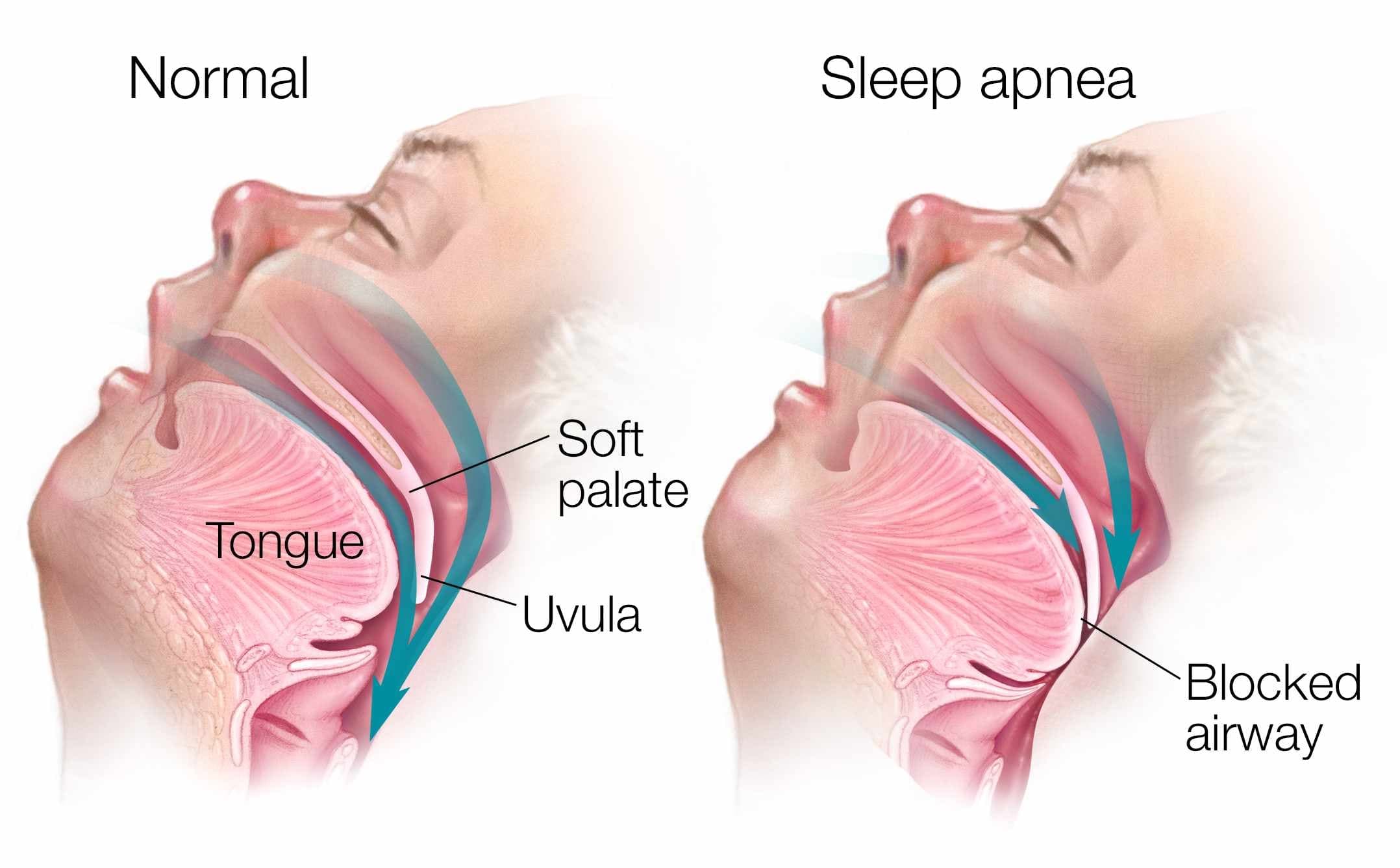 Sleep apnea is when you stop breathing while sleeping and your body realizes this and wakes up just long enough to gasp…